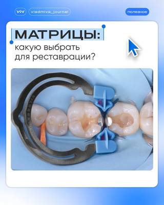Матрицы: выбираем форму для идеального контактного пункта.